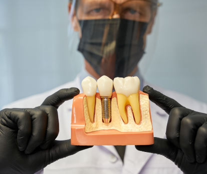 زراعة اسنان